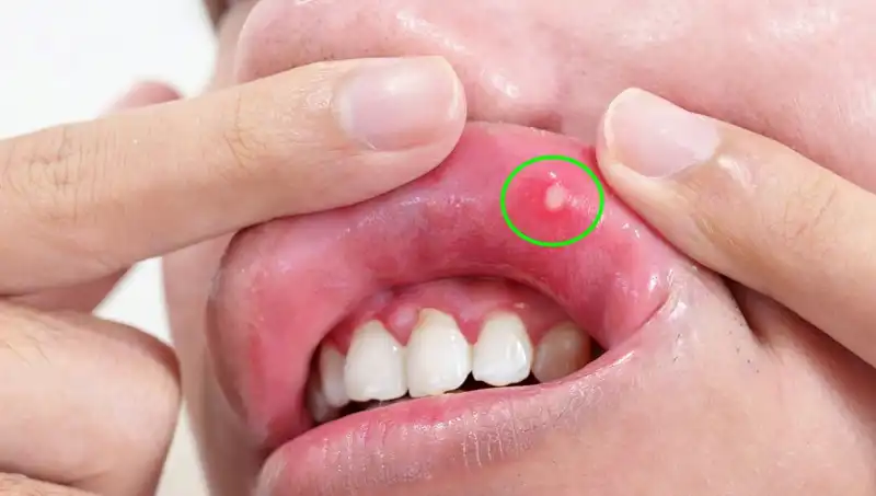 5 Belirgin B Vitamini Eksikliği Belirtisi: Vücudunuzu Tehdit Edebilecek İşaretler