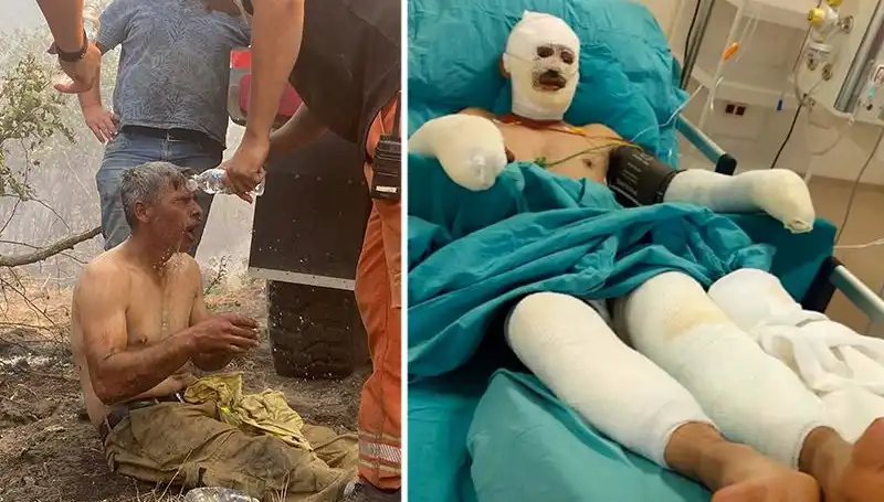 Orman İşçisinin Feryadı: "Yanıyorum" Tedavi Süreci Devam Ediyor